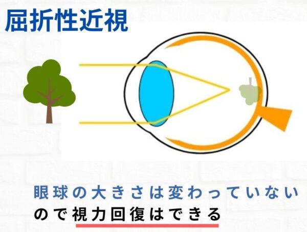 屈折性近視